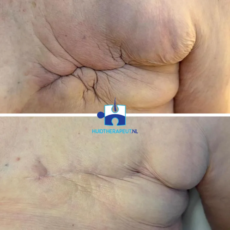 Resultaat littekentherapie borst