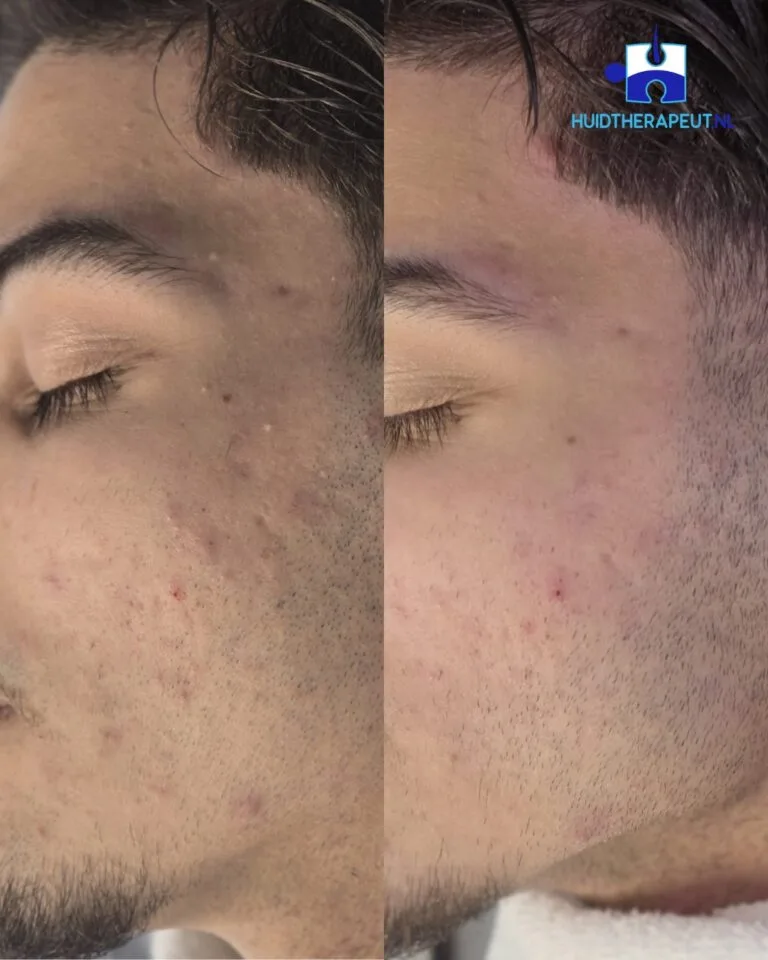 Resultaat na 1 chemische peeling + huidverzorging van Lira Clinical