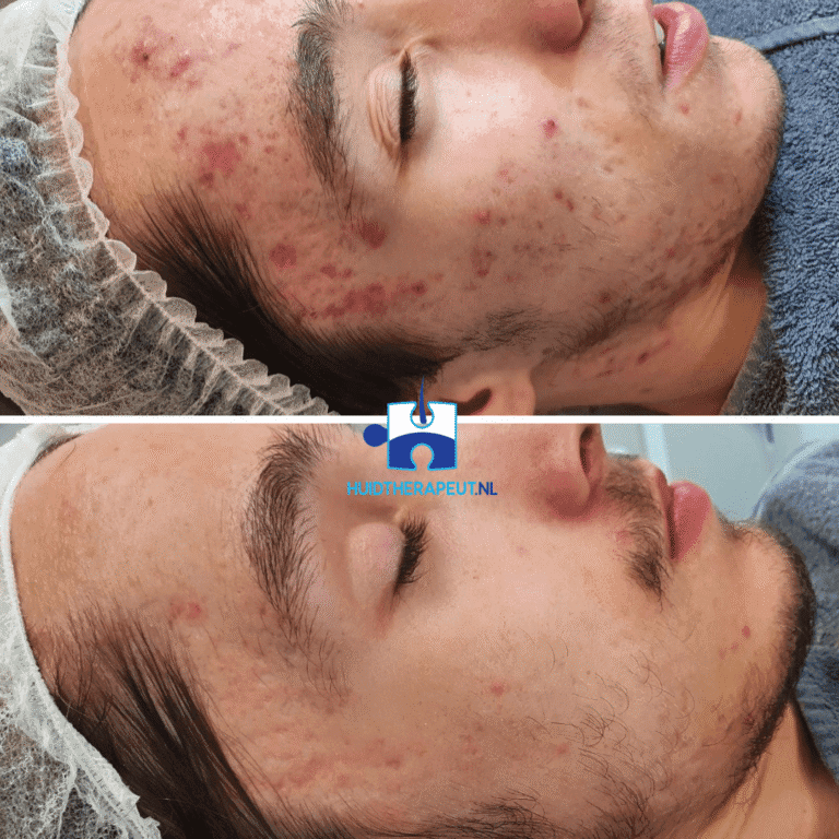 Acne - chemische peeling behandeling - resultaat na zes behandelingen