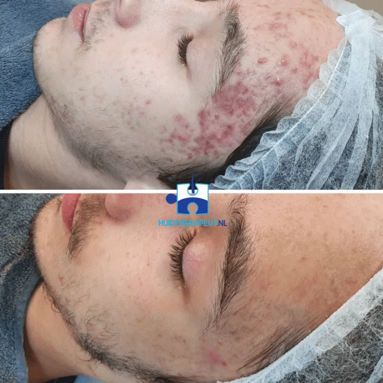 Acne - chemische peeling behandeling - resultaat na zes behandelingen