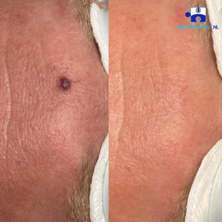 Spider naevi - resultaat na een keer lasertherapie